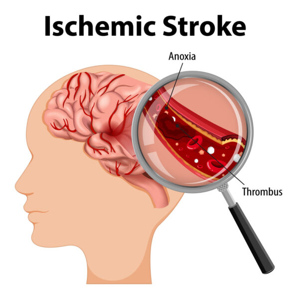 Accident vascular cerebral
