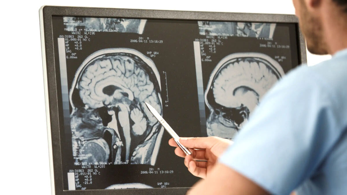 Ateroscleroza cerebrala