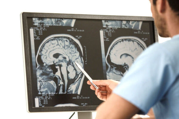 Ateroscleroza cerebrala